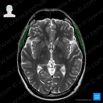 Músculo temporal (Musculus temporalis); Imagen: 