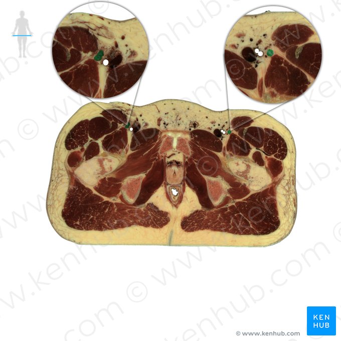 Nervo femoral (Nervus femoralis); Imagem: National Library of Medicine