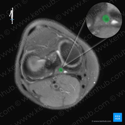 Posterior cruciate ligament (Ligamentum cruciatum posterius); Image: 