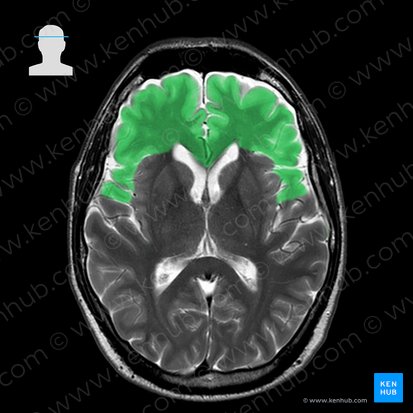 Lobo frontal (Lobus frontalis); Imagem: 