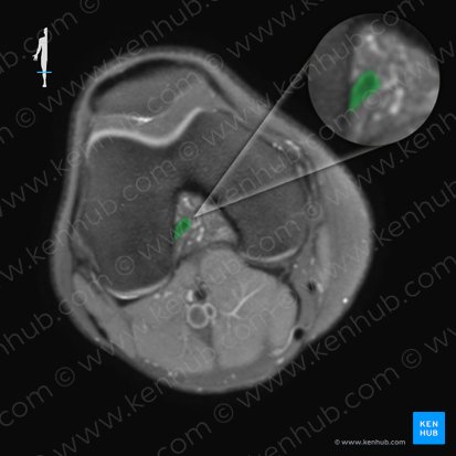 Ligamentum cruciatum anterius (Vorderes Kreuzband); Bild: 