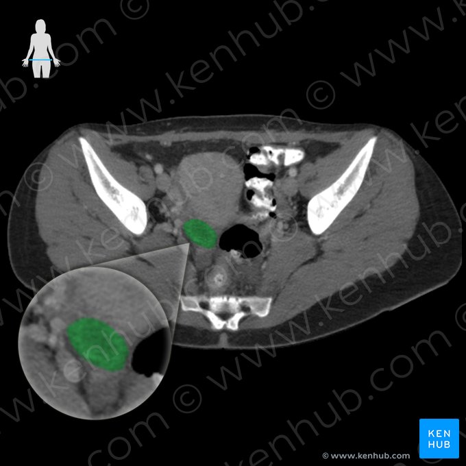 Right ovary (Ovarium dexter); Image: 