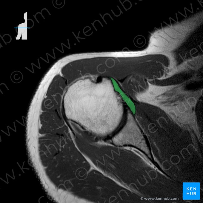 Ligamentos glenohumerales (Ligamenta glenohumeralia); Imagen: 