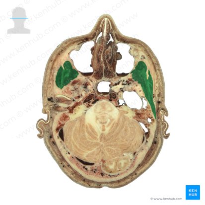 Músculo temporal (Musculus temporalis); Imagen: National Library of Medicine