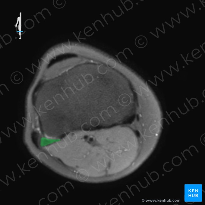 Fíbula (Fibula); Imagen: 