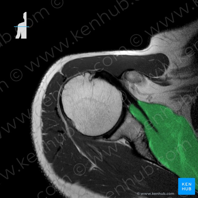 Músculo subescapular (Musculus subscapularis); Imagen: 