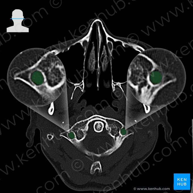 Transverse foramen of vertebra (Foramen transversarium vertebrae); Image: 