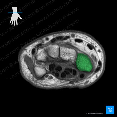 Scaphoid bone (Os scaphoideum); Image: 
