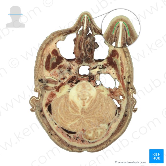 Cartilagem nasal lateral (Cartilago nasi lateralis); Imagem: National Library of Medicine