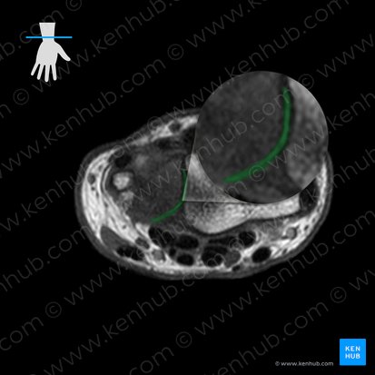 Distal radioulnar joint (Articulatio radioulnaris distalis); Image: 