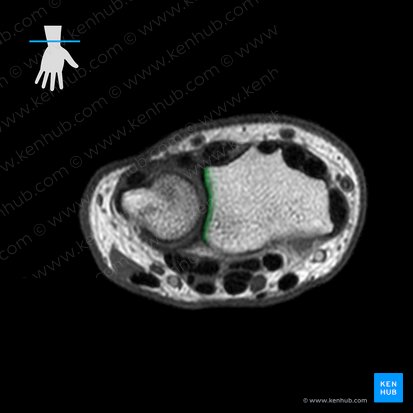 Ulnar notch of radius (Incisura ulnaris radii); Image: 