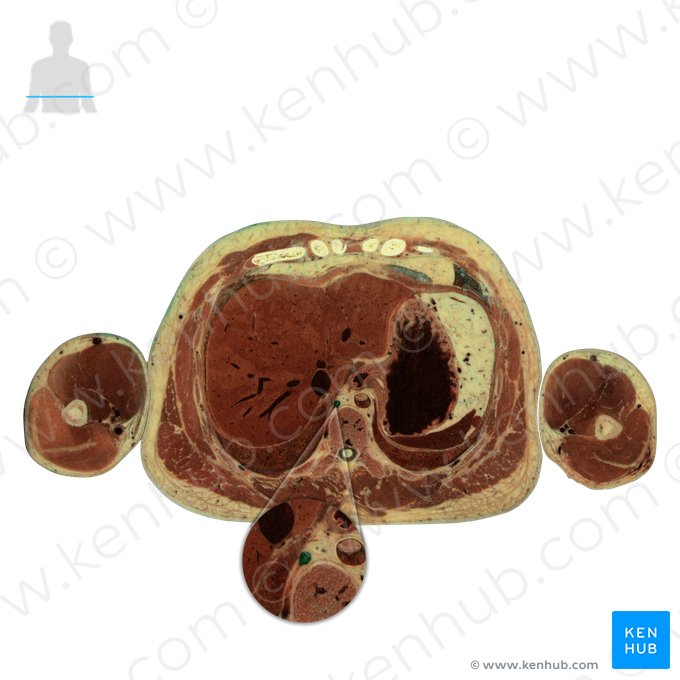 Vena azygos (Azygosvene); Bild: National Library of Medicine