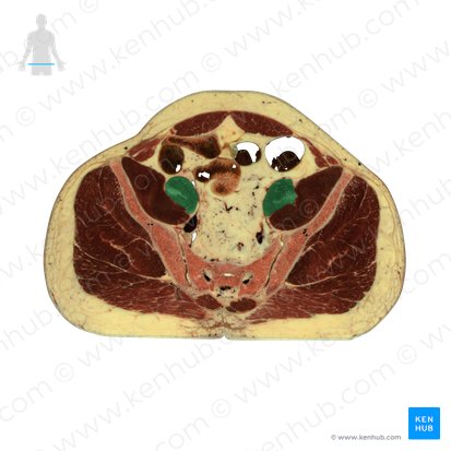 Musculus psoas major (Großer Lendenmuskel); Bild: National Library of Medicine