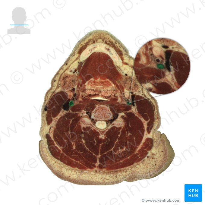 Internal carotid artery (Arteria carotis interna); Image: National Library of Medicine