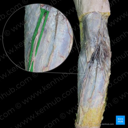 Vena cephalica (Kopfvene); Bild: 