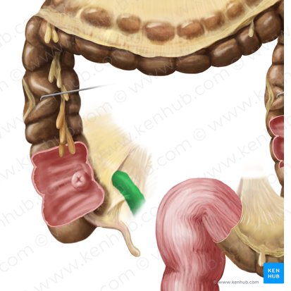 Pars terminalis ilei (Endteil des Krummdarms); Bild: Begoña Rodriguez