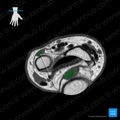 Tendon of extensor carpi ulnaris muscle (Tendo musculi extensoris carpi ulnaris); Image: 