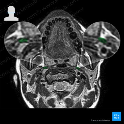 Músculo estilofaríngeo (Musculus stylopharyngeus); Imagem: 