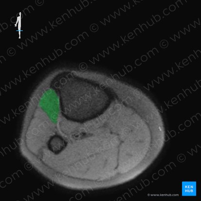 Músculo tibial anterior (Musculus tibialis anterior); Imagem: 