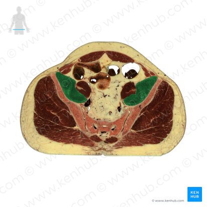 Iliacus muscle (Musculus iliacus); Image: National Library of Medicine