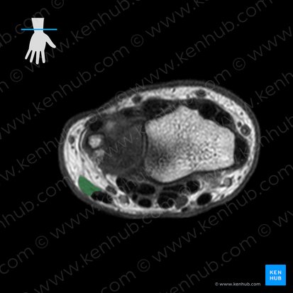 Flexor carpi ulnaris muscle (Musculus flexor carpi ulnaris); Image: 