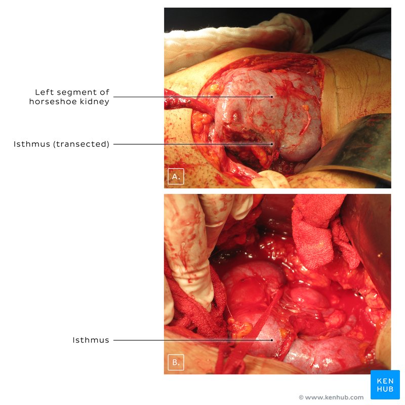 Horseshoe kidney nephrectomy