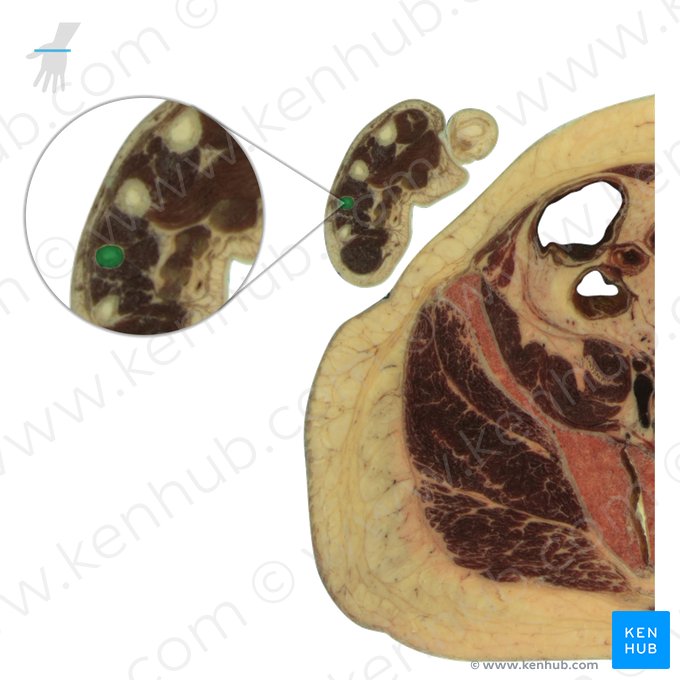 4th metacarpal bone (Os metacarpi 4); Image: National Library of Medicine