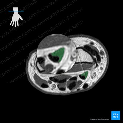 Flexor pollicis longus muscle (Musculus flexor pollicis longus); Image: 