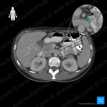 Inferior mesenteric vein (Vena mesenterica inferior); Image: 