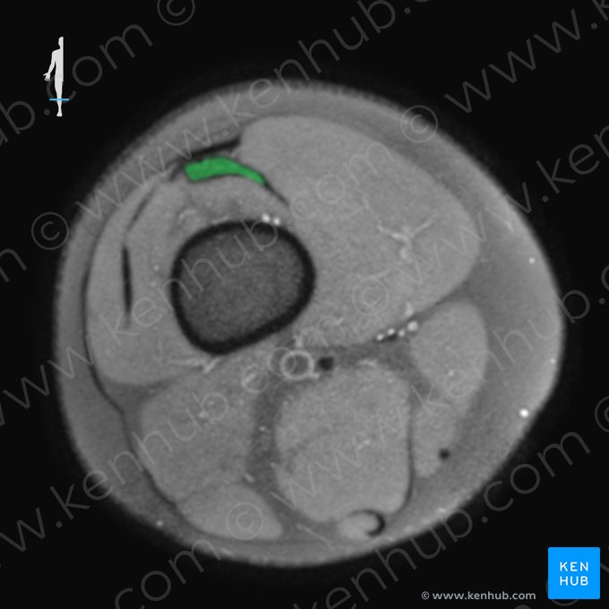 Tendon du muscle vaste intermédiaire (Tendo musculi vasti intermedii); Image : 