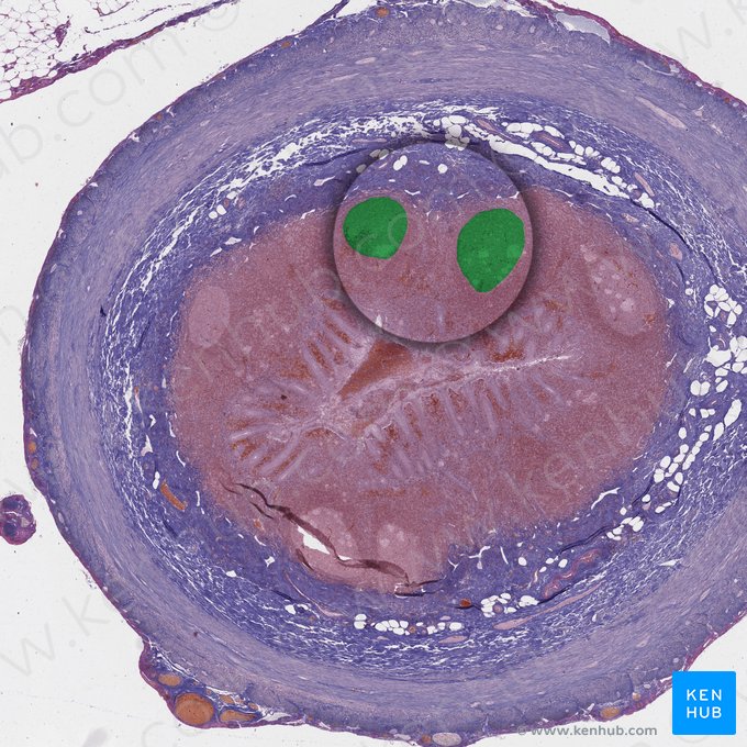 Lymphatic tissue of appendix; Image: 