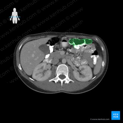 Colon transverso (Colon transversum); Imagen: 