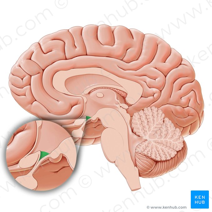 Recessus infundibuli ventriculi tertii (Recessus infundibuli des dritten Ventrikels); Bild: Paul Kim