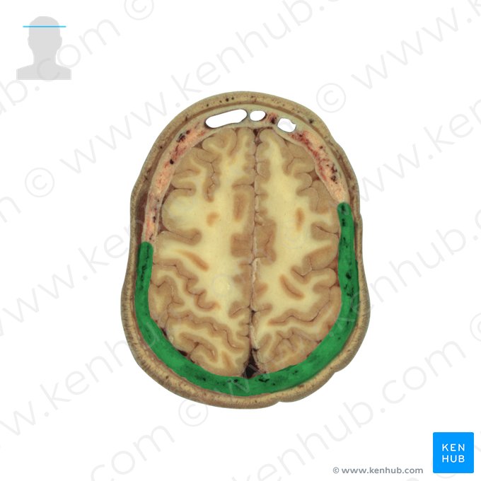 Osso parietal (Os parietale); Imagem: National Library of Medicine