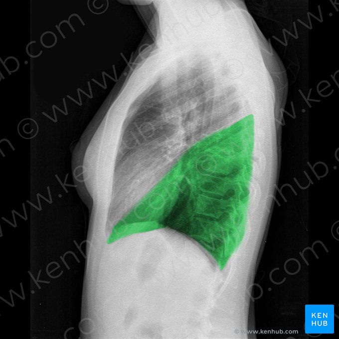 Lóbulo inferior del pulmón izquierdo (Lobus inferior pulmonis sinistri); Imagen: 
