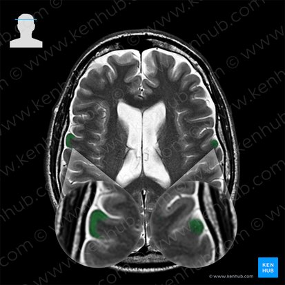 Precentral gyrus (Gyrus precentralis); Image: 