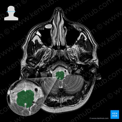 Medulla oblongata (Verlängertes Mark); Bild: 