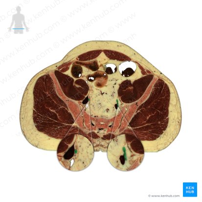 Internal iliac artery (Arteria iliaca interna); Image: National Library of Medicine