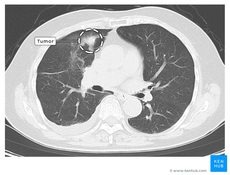 Lung tumor - axial contrast-enhanced CT