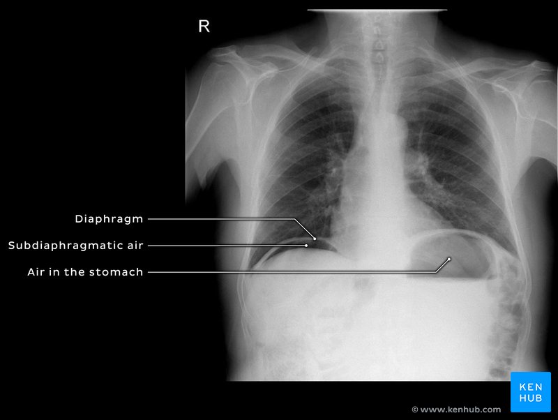 Pneumoperitoneum