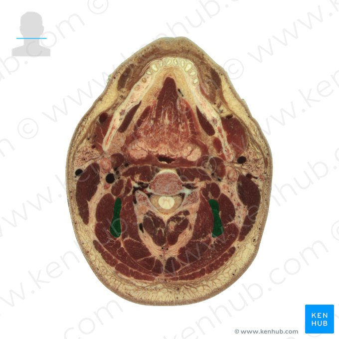 Músculo esplênio do pescoço (Musculus splenius cervicis); Imagem: National Library of Medicine