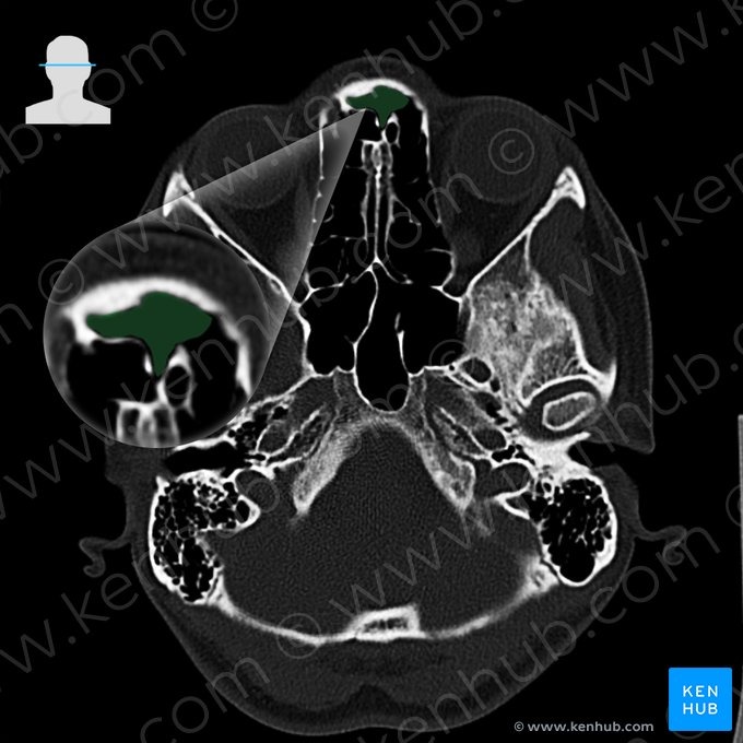 Seio frontal (Sinus frontalis); Imagem: 