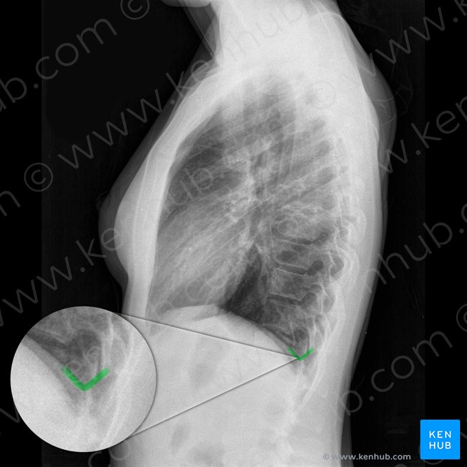 Ângulo costofrênico posterior esquerdo (Angulus costophrenicus posterior sinister); Imagem: 