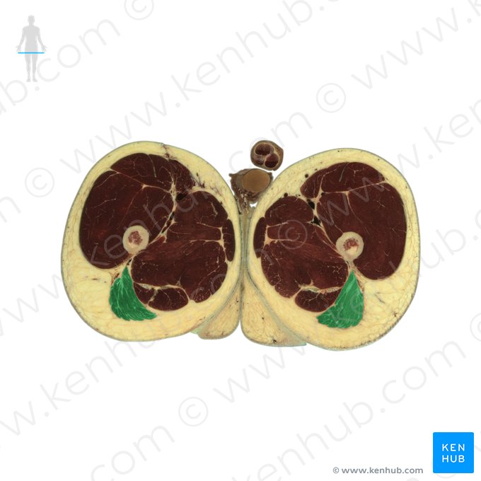 Musculus gluteus maximus (Großer Gesäßmuskel); Bild: National Library of Medicine