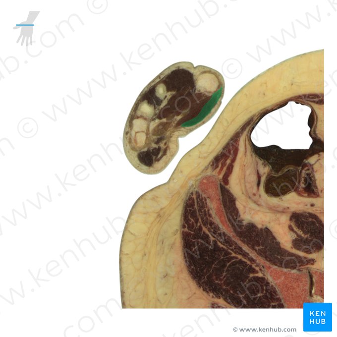 Musculus abductor pollicis brevis (Kurzer Daumenspreizer); Bild: National Library of Medicine