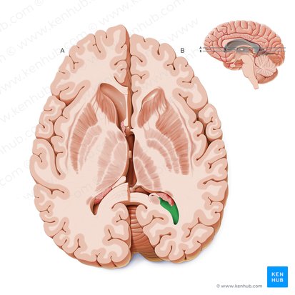 Occipital horn of lateral ventricle (Cornu occipitale ventriculi lateralis); Image: Paul Kim