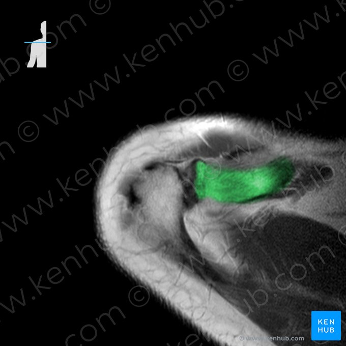 Clavícula (Clavicula); Imagen: 