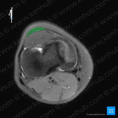 Patellar ligament (Ligamentum patellae); Image: 