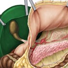 Cirrhosis