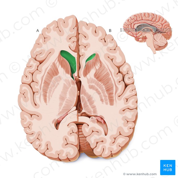 Asta frontal del ventrículo lateral (Cornu frontale ventriculi lateralis); Imagen: Paul Kim